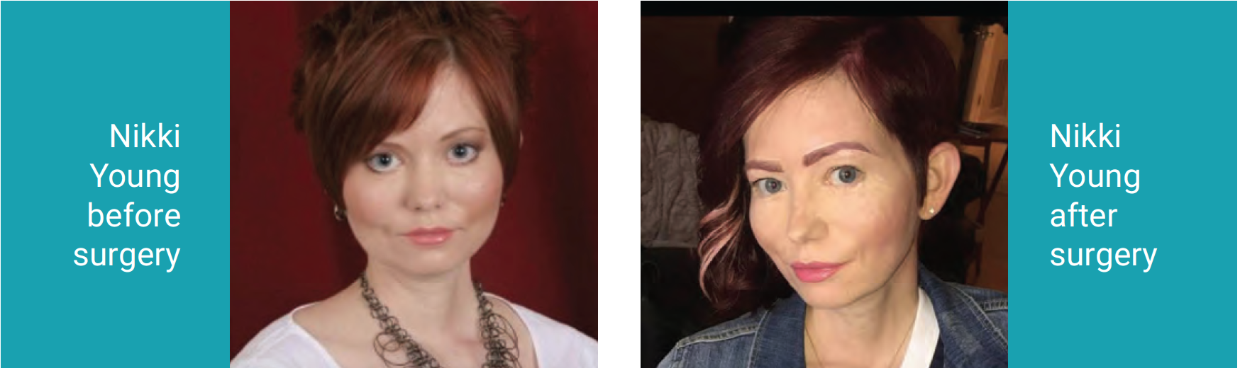 before and after eye surgery