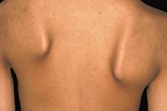 Website-ScapularFixation-min FSHD shoulders
