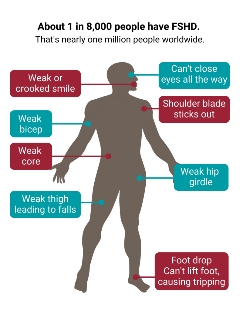 Muscular Dystrophy Symptoms