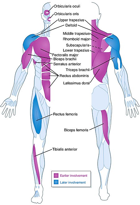 FSHDBodyDiagram